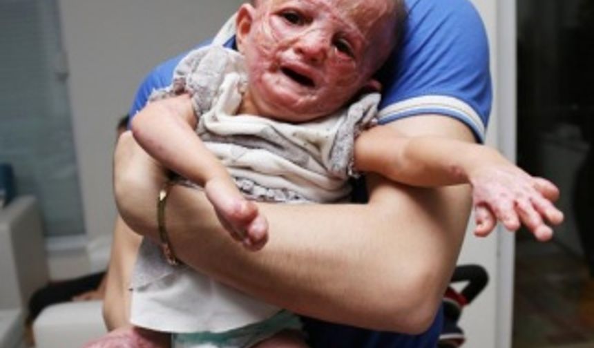 Suriye'deki savaş minik bedenlerini yaktı